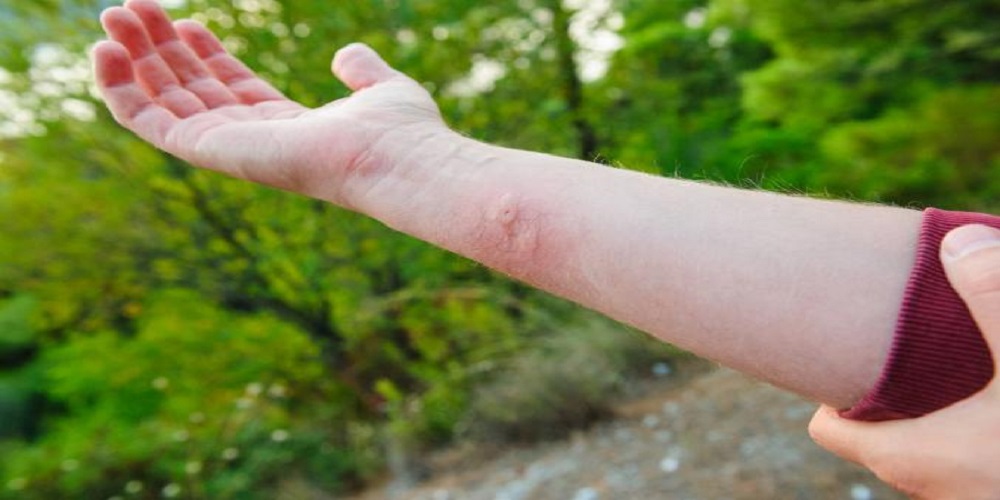 how to treat a yellow jacket sting
